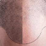 WHAT IS FOLLICULAR UNIT EXTRACTION (FUE)