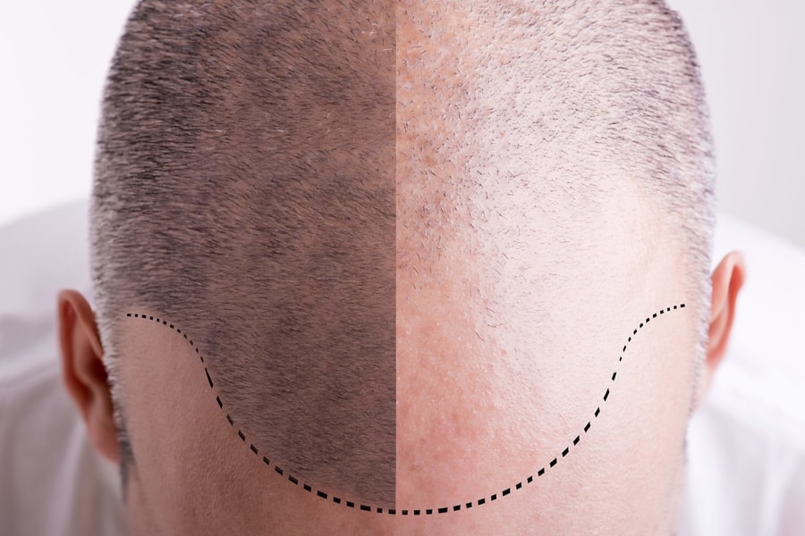 WHAT IS FOLLICULAR UNIT EXTRACTION (FUE)