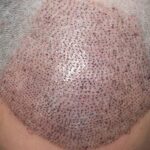 Is It Possible To Fail In A Hair Transplant Procedure