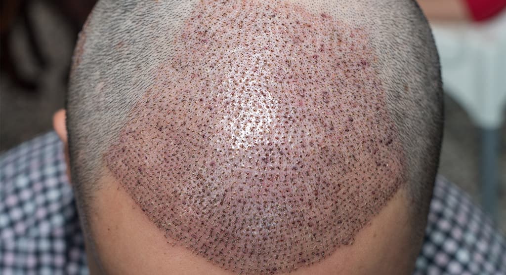 Is It Possible To Fail In A Hair Transplant Procedure